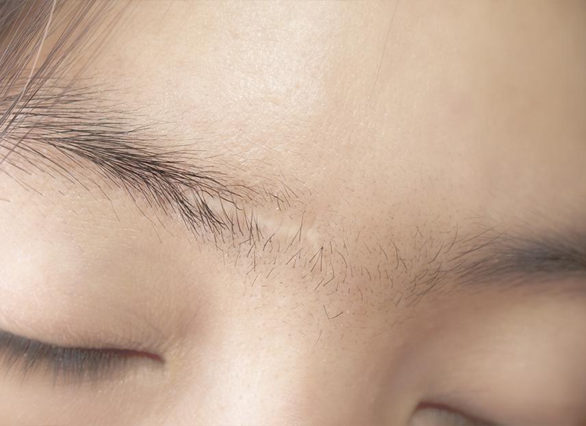 Narben in den Augenbrauen: Wie können Sie sie kaschieren?